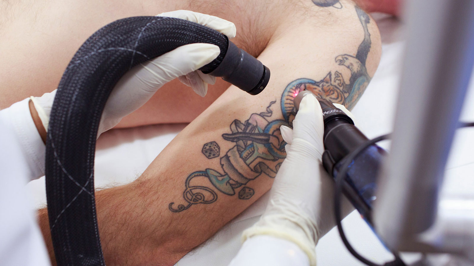 tatueringsborttagning med laser