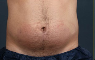 coolsculpting-before-after1.jpg