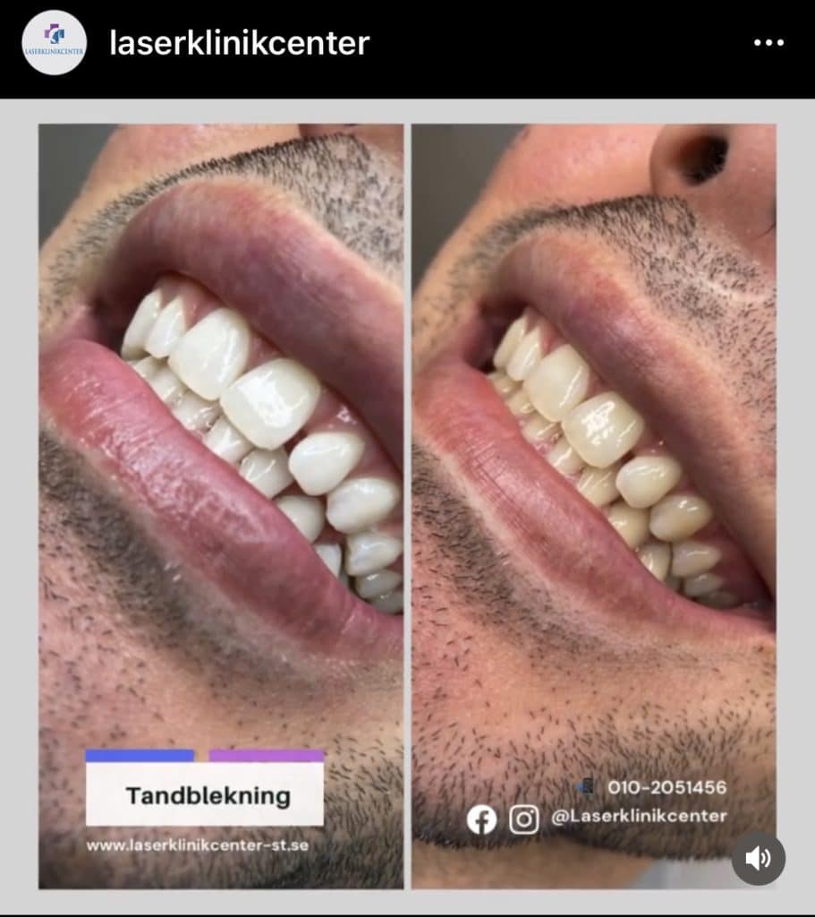 Blekning av tänder