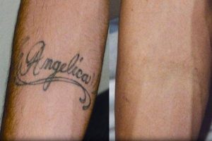 Tatueringsborttagning Stockholm